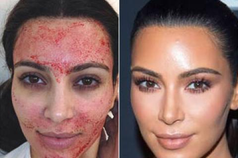 Shamelessly using a photo of a Kardashian to illustrate what a vampire facial with platelet-rich plasma looks like